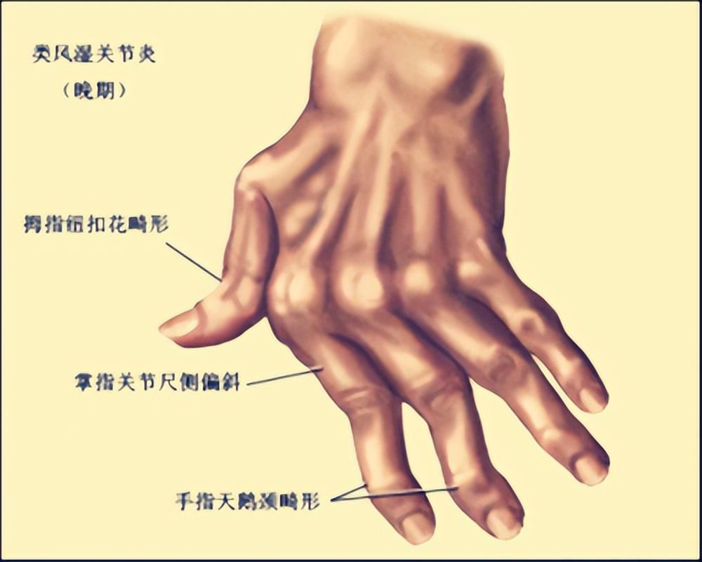 晚期类风湿病最佳治疗方法,晚期类风湿去哪里治