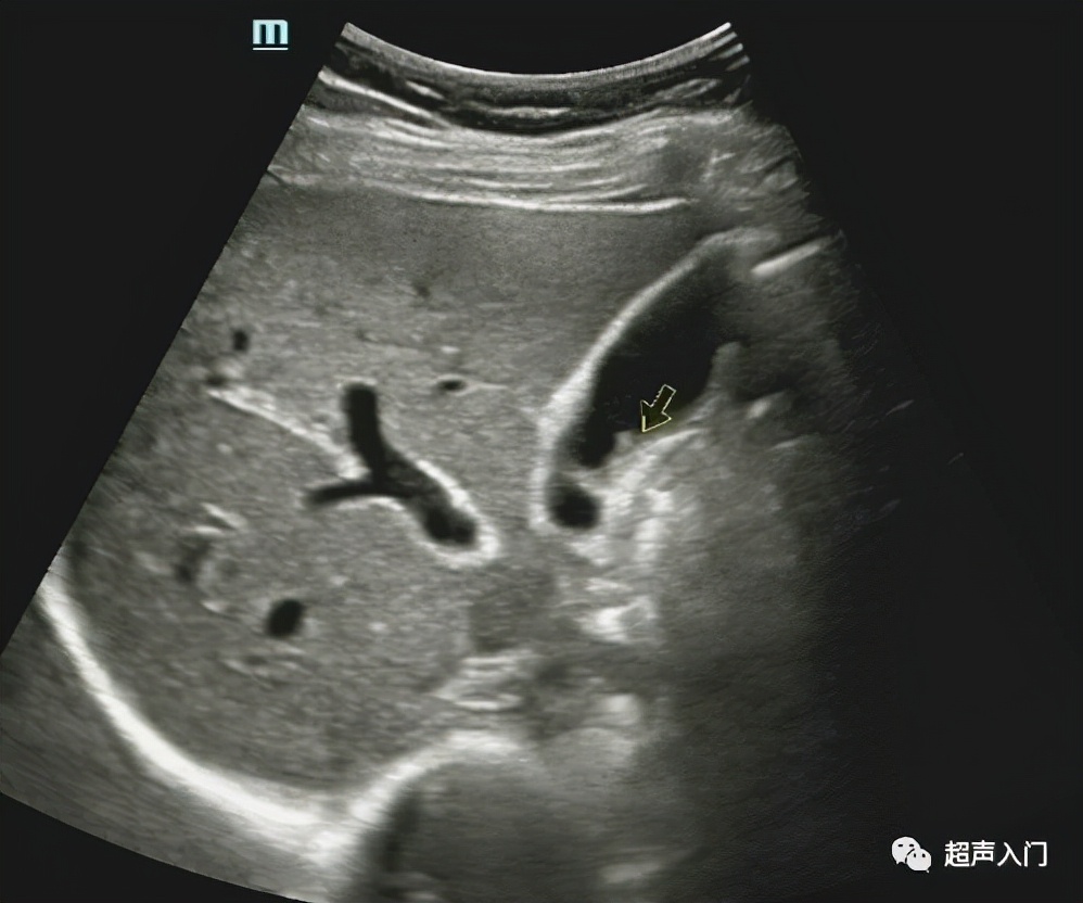 超声学自己能学吗,超声初学者有何窍门