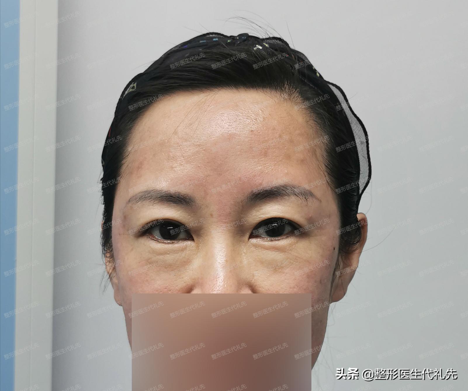 皮肤松弛型的眼袋是不是假性眼袋,眼袋上的小细纹是怎样形成的