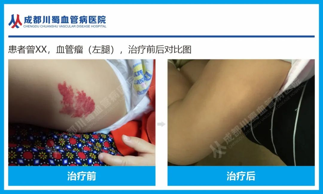 小红斑，*麻大**烦！警惕血管瘤健康隐患