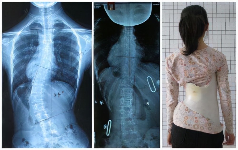 脊柱侧弯保守治疗可以报销吗,脊柱侧弯手术15万能报销多少