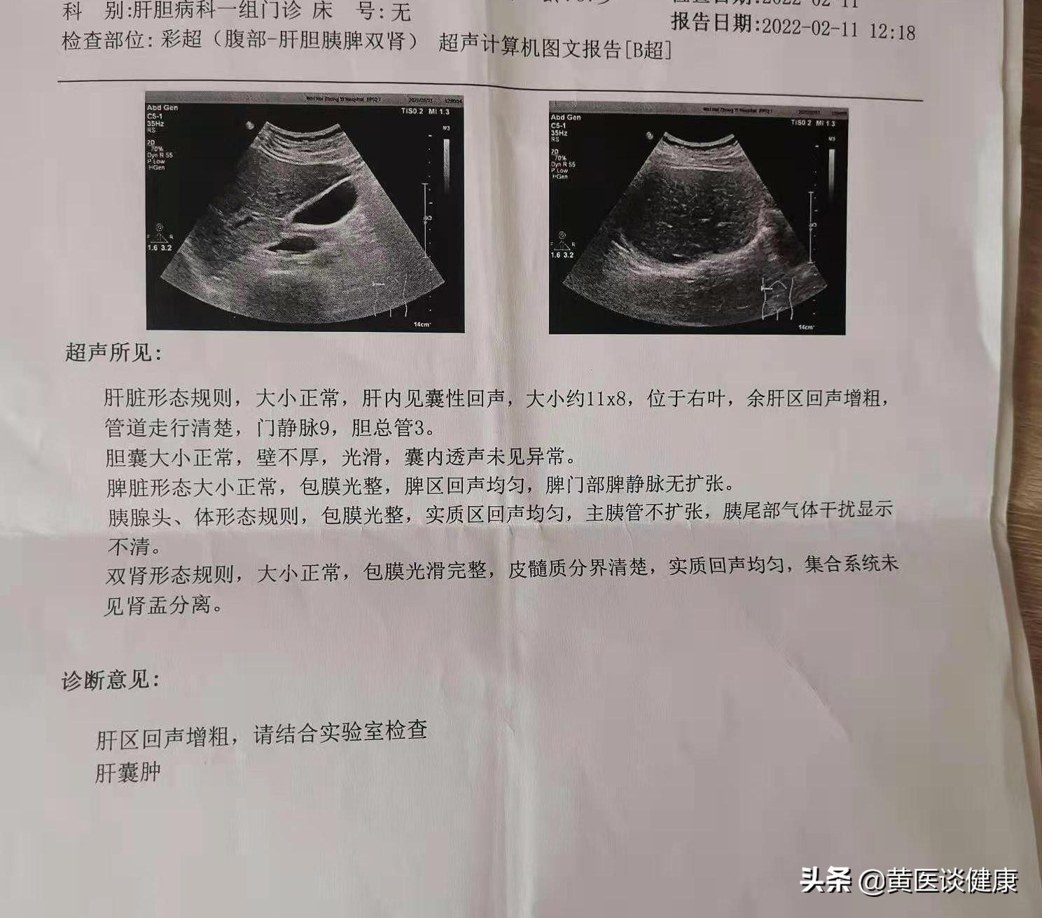 小三阳肝功能正常dna2次方,小三阳肝功能正常dna低于1000