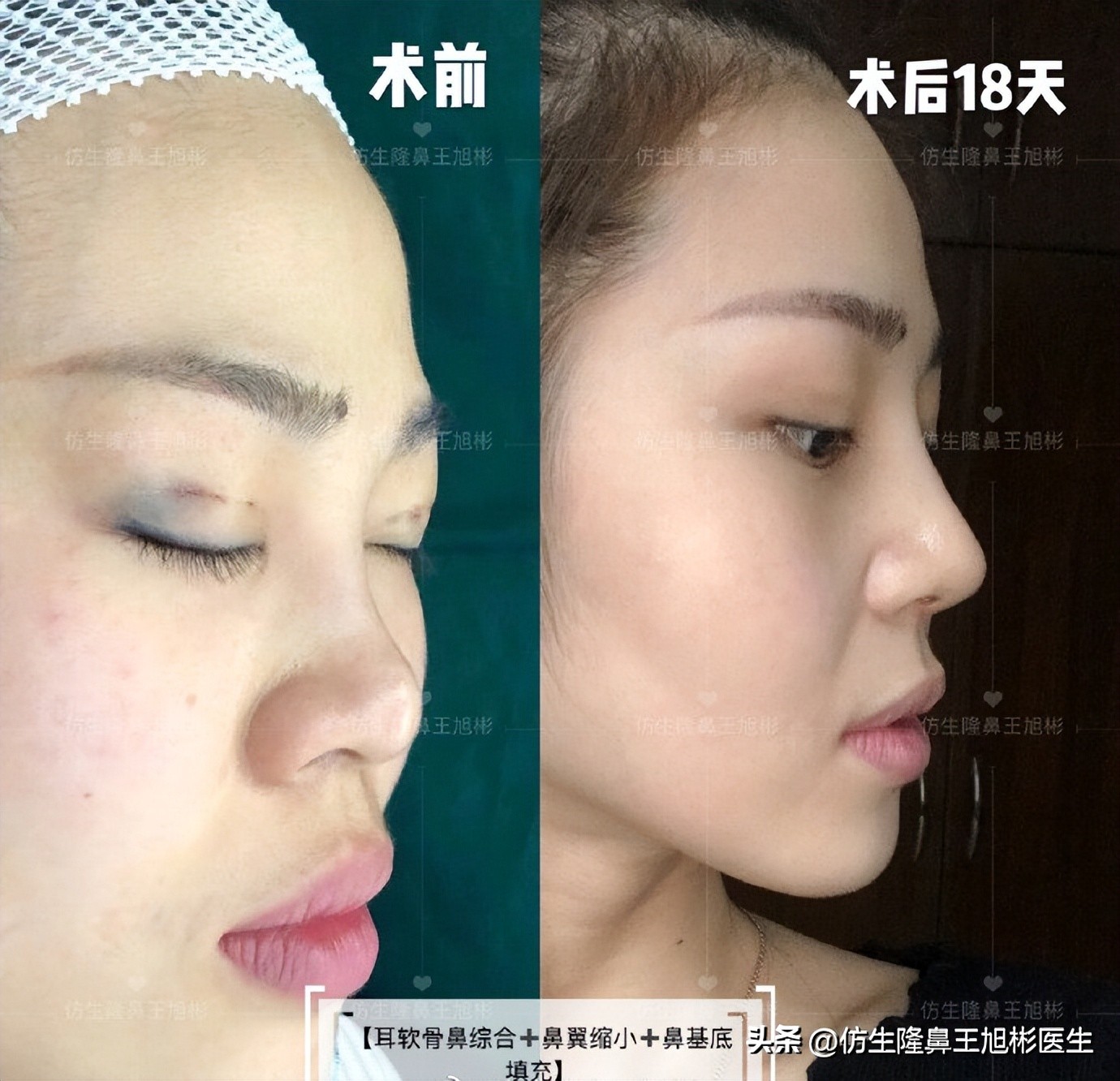 整形鼻部科普知识,隆鼻整形科普知识