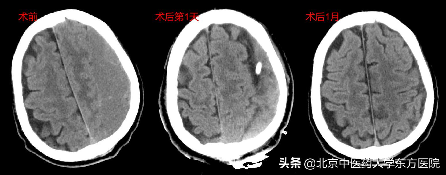 老年人慢性硬膜下血肿,老年性慢性硬膜下血肿的注意事项