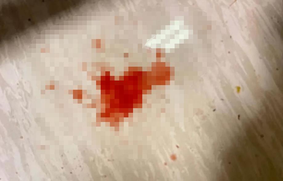 怀孕6周突然流鲜血有腹痛,孕妇呕吐到呕血是怎么回事