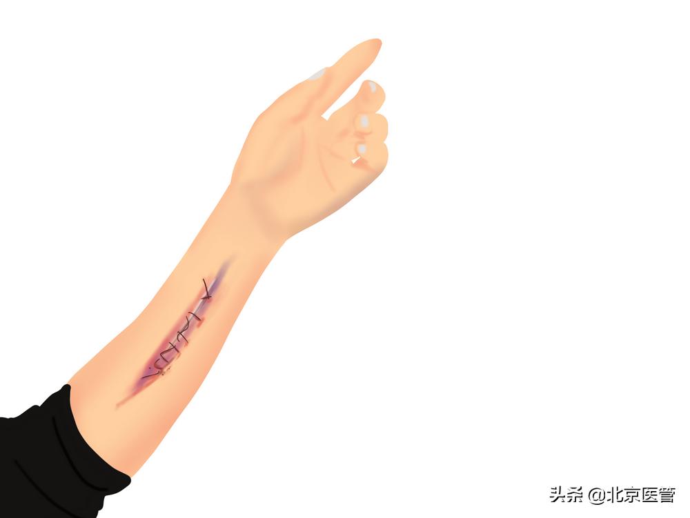 外伤消毒碘伏推荐,家用伤口消毒液选什么好