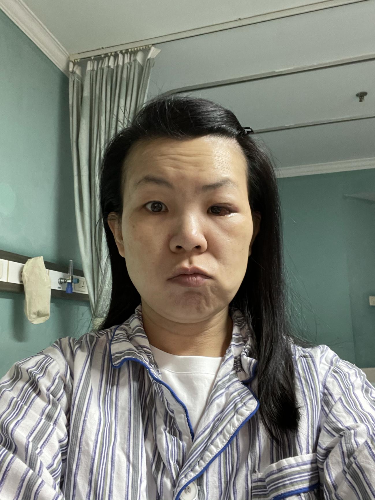 眼眶蜂窝织炎看病经验分享,患了急性眼眶蜂窝织炎如何治疗