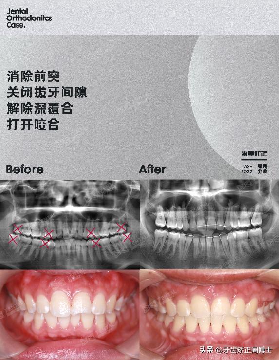 闭嘴巴下巴有核桃纹做什么手术,为什么下巴会有像核桃一样的纹路