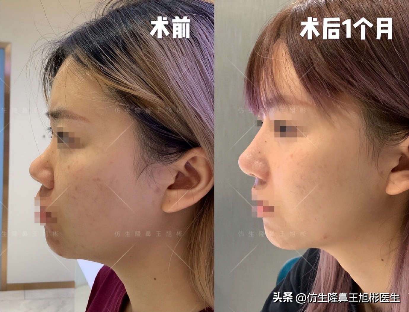 短鼻延长,短鼻塌鼻可以逆袭变长吗