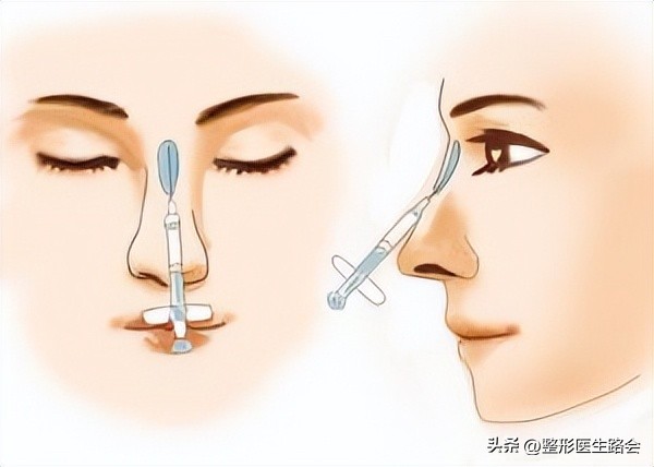 玻尿酸隆鼻立竿见影吗,玻尿酸隆鼻适合哪些鼻型