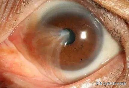 眼球两边有黄肉是什么原因,白眼球上长肉是怎么回事