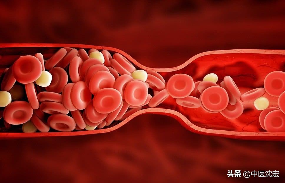 血瘀体质易得心梗吗,血瘀体质容易心梗