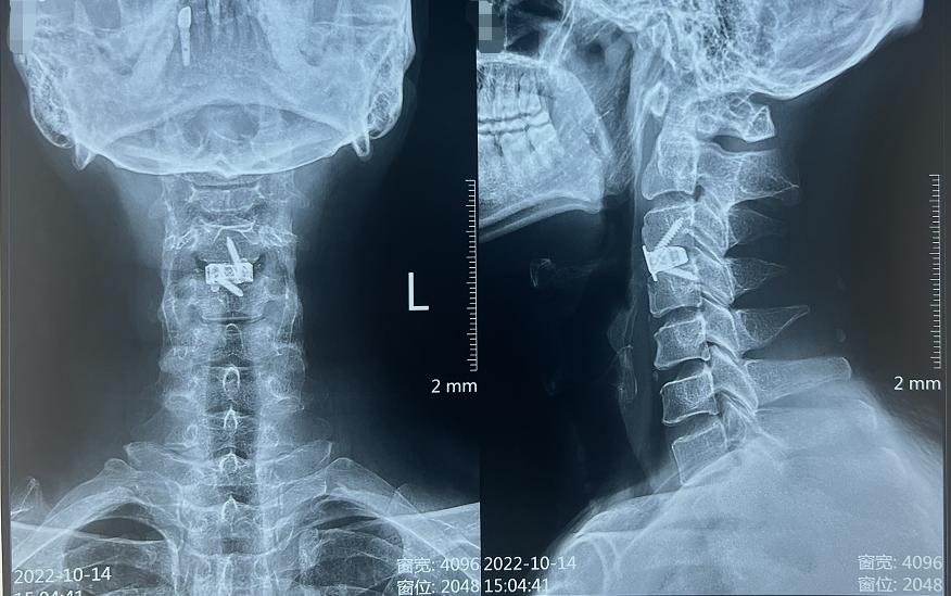 当夜跑爱好者遇上“颈椎病”：颈椎微创手术后多久可以恢复正常？
