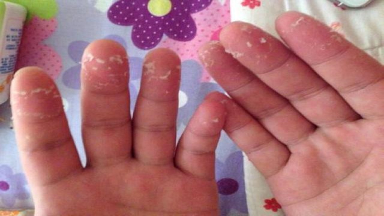 缺乏维生素b2时身体有什么表现,为什么会造成维生素b2的缺乏