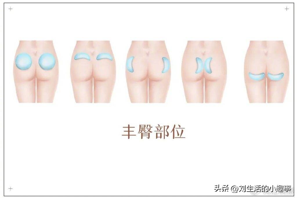 网红丰臀手术死亡,隆臀手术死亡的女子