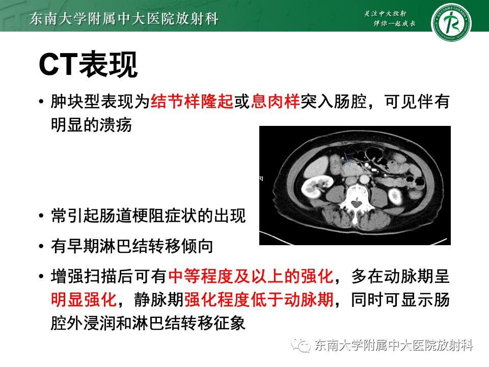 小肠间质瘤最新治疗中药方,小肠间质瘤基因检测