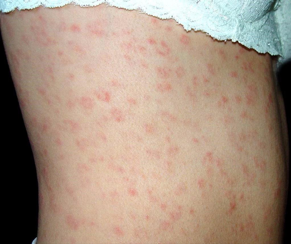 跟男朋友接触皮肤会变好吗,男人得了梅毒的征兆会不会传染