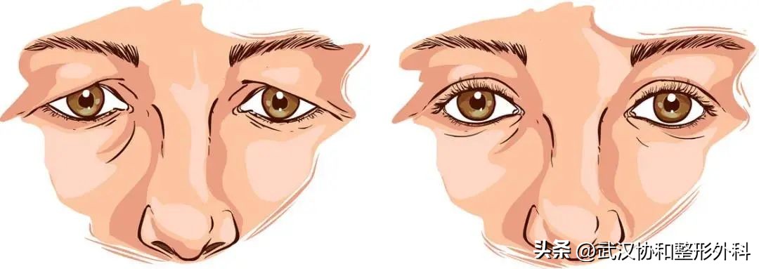 平行双眼皮手术图片,埋线双眼皮手术价格