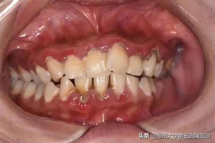 请问医生牙龈出血是怎么了,医学科普牙龈总是出血该怎么办呢