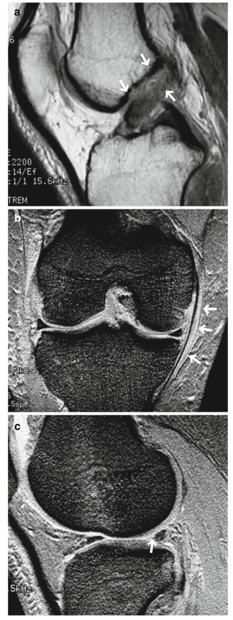 磁共振诊断半月板撕裂但没有症状,半月板桶柄状撕裂磁共振影像表现