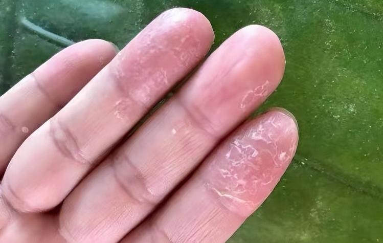 哪3种洗洁精用了会引起癌症,长期使用洗洁精会得癌症吗