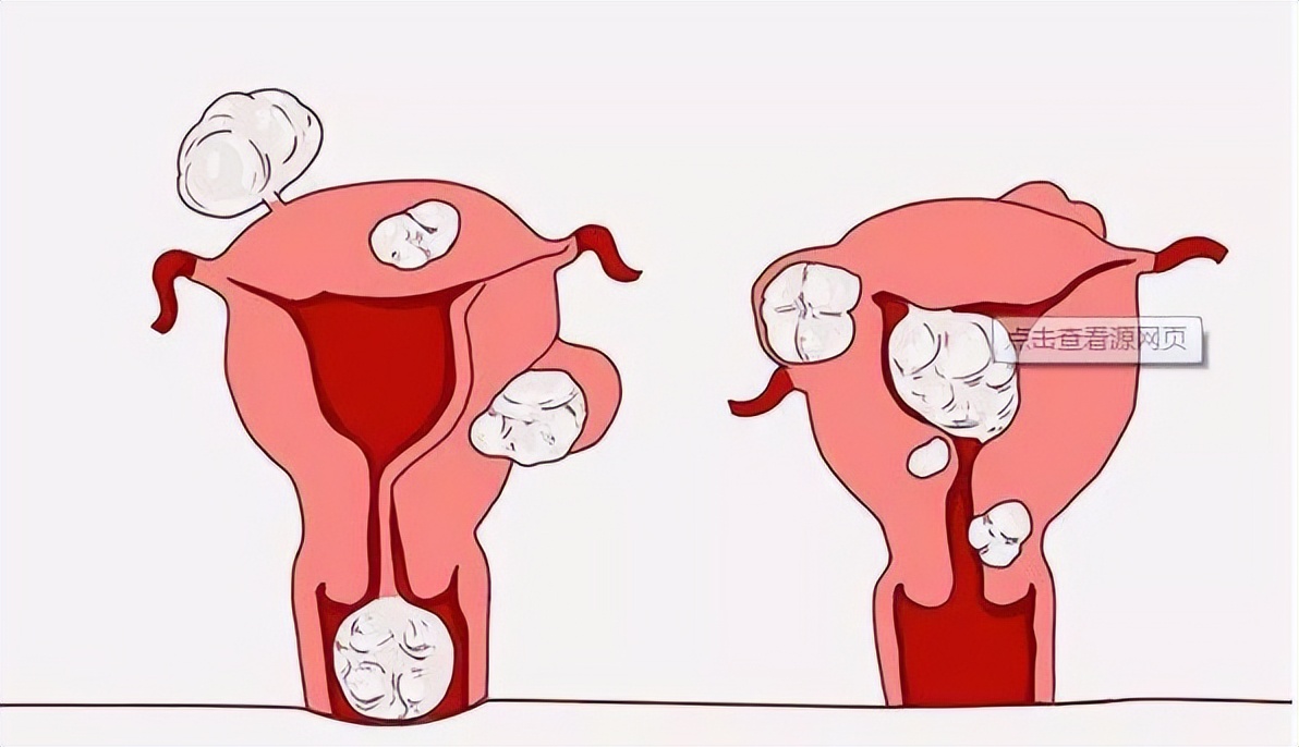 女性霉菌感染是怎么感染的,女童霉菌感染是怎么引起的呢