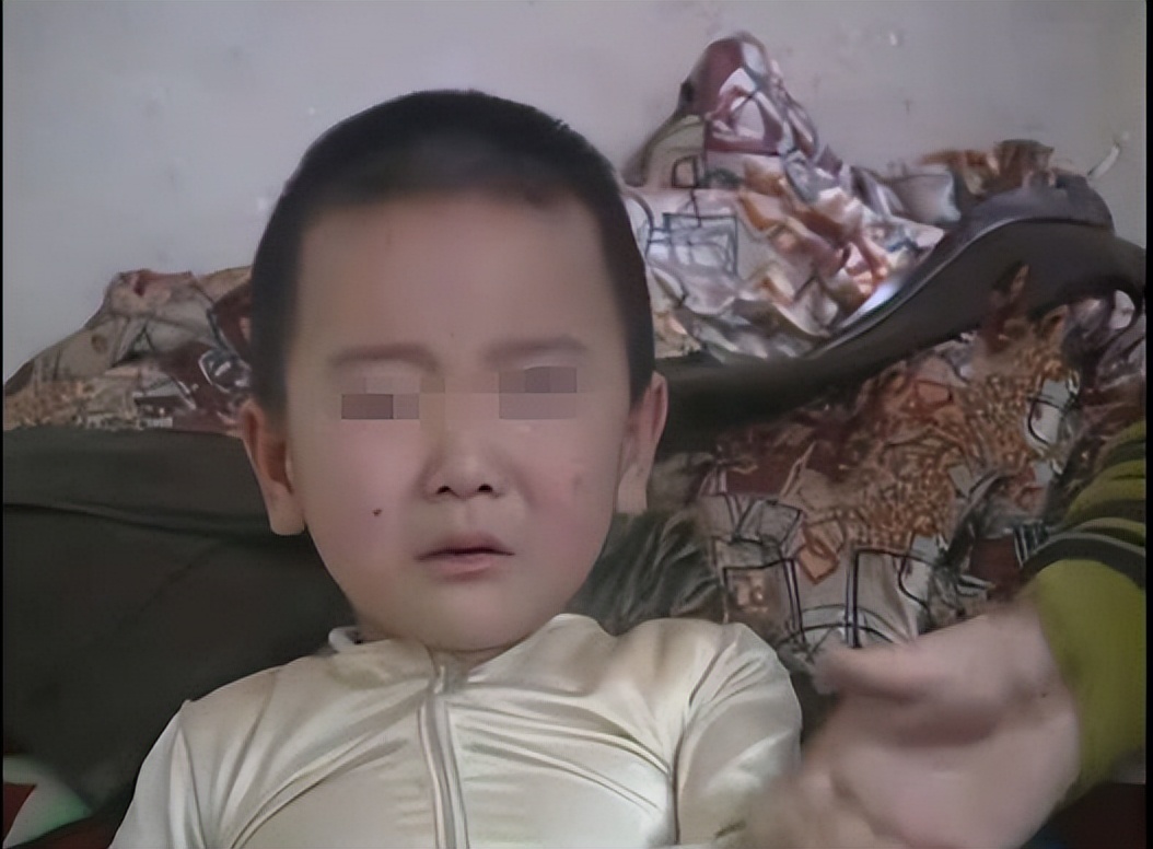 2010年河北行唐，儿子患病身长“巨型黑痣”，母亲为救子割皮移植