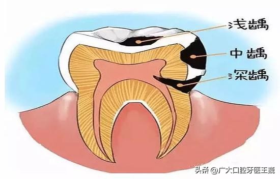 牙疼想知道自己是哪种牙疼,牙疼也算病一招解决绝对有效