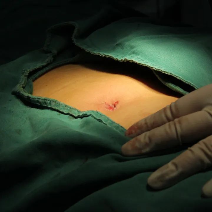 “术过无痕”,一个小孔解决孩子大问题