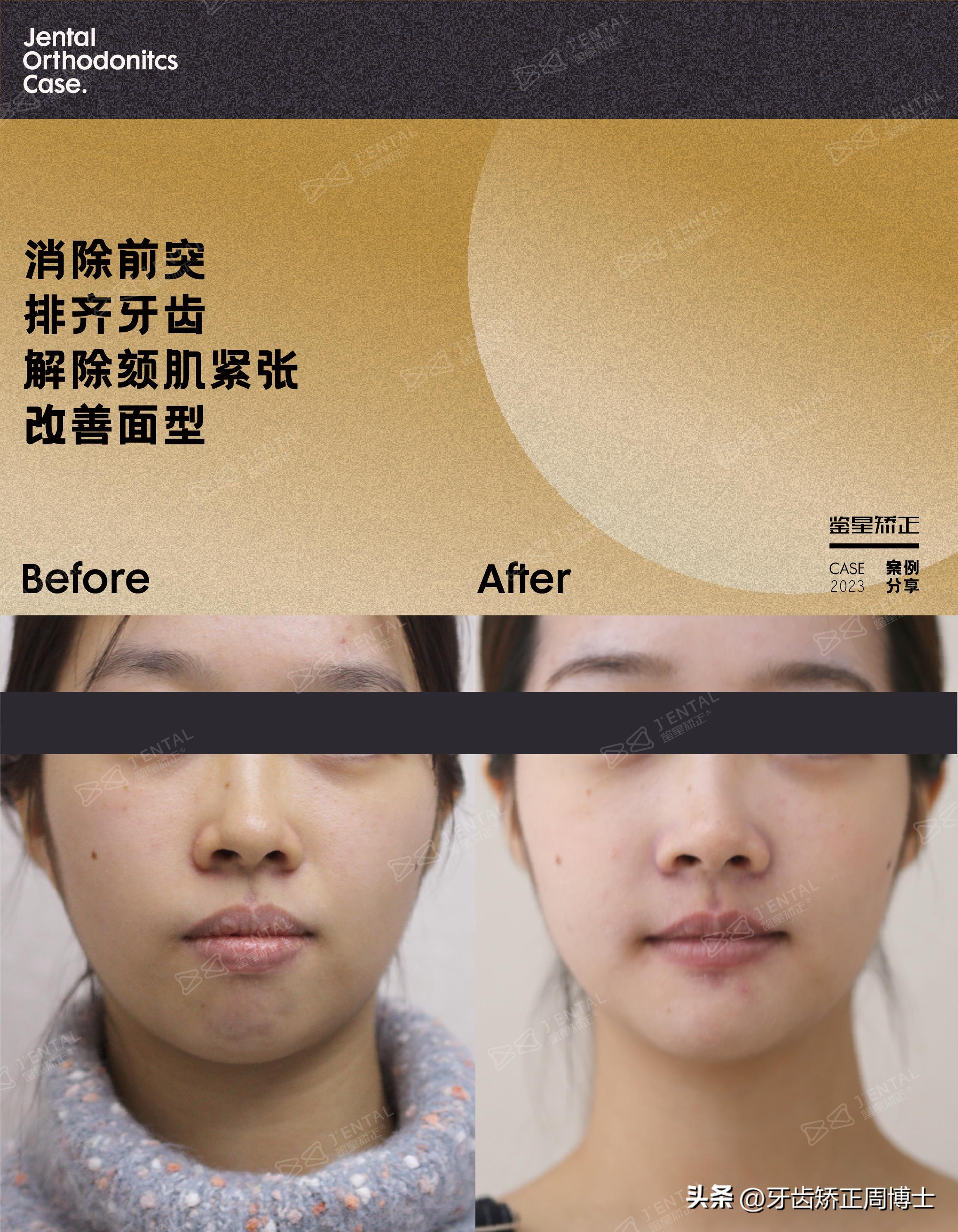 龅牙骨钉矫正演示,骨性龅牙打骨钉前后对比