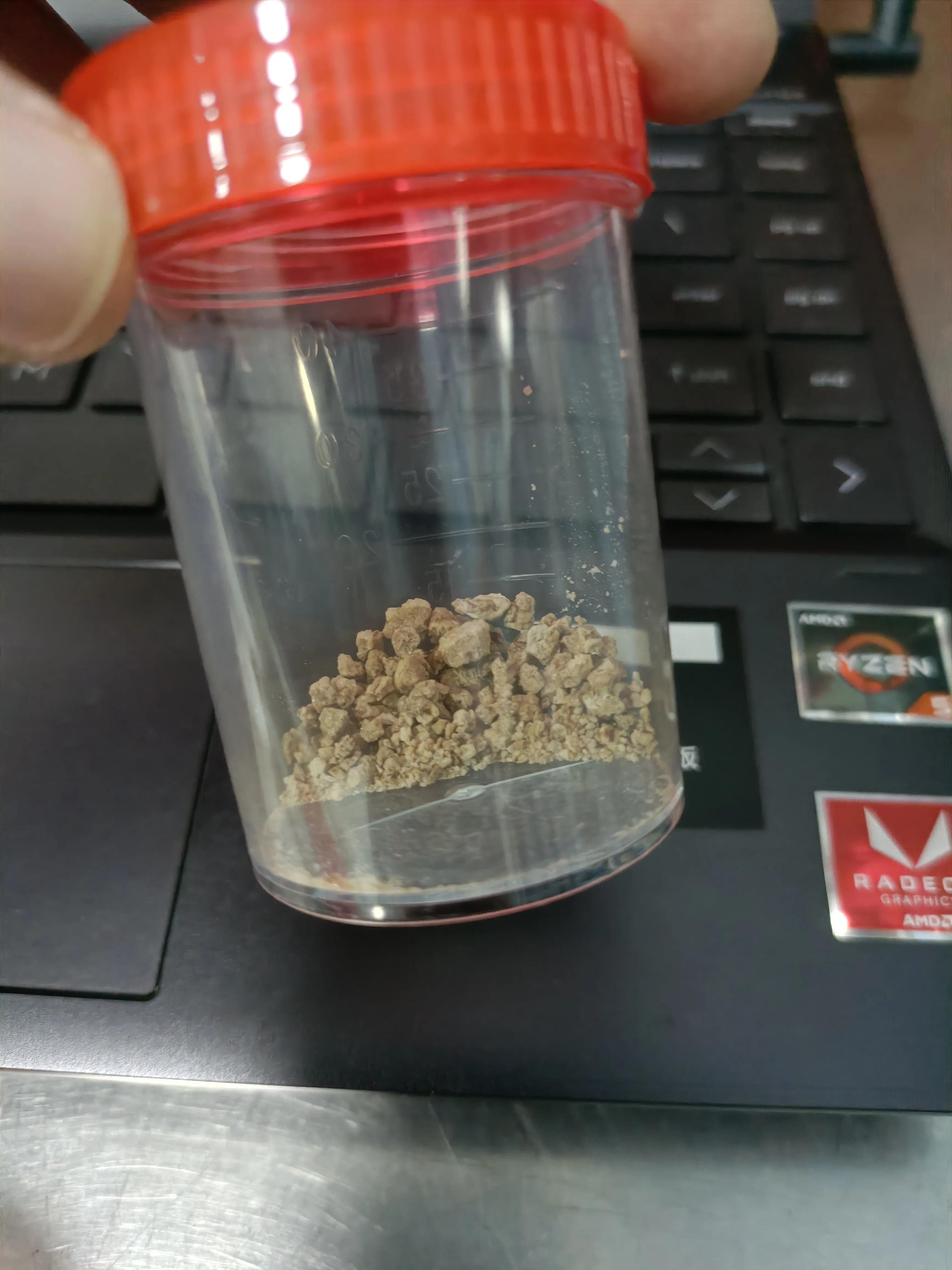 肾结石经皮肾镜两次手术间隔多久,两公分的肾结石需要动几次手术