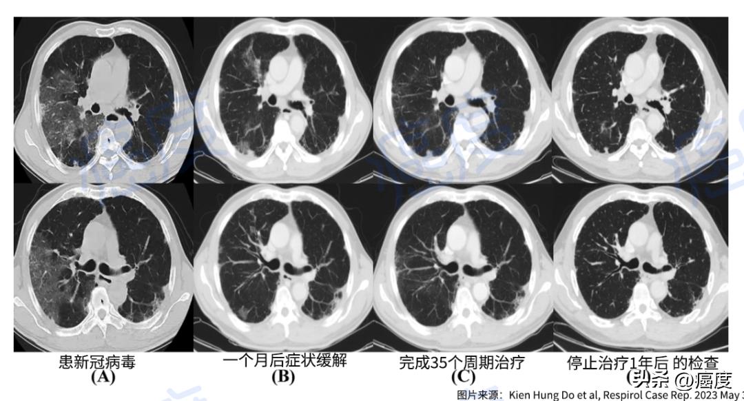 肺癌靶向耐药后可以用pd1吗,没靶向药没pdl1怎么治肺癌