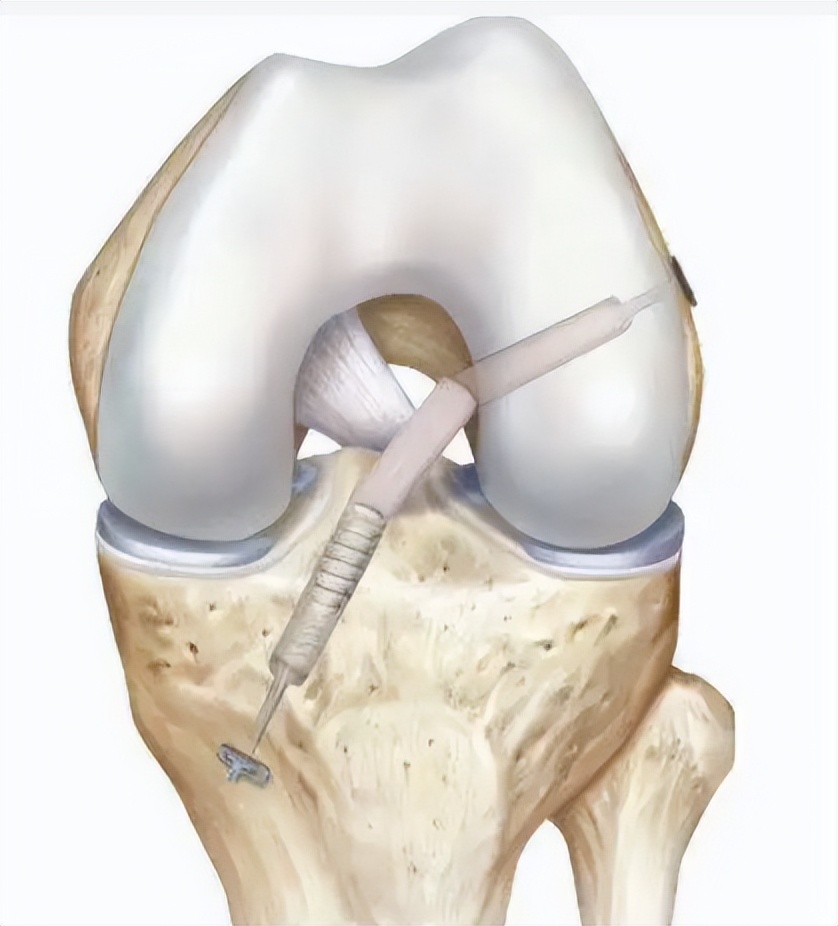 韧带断裂微创手术能恢复正常吗,打篮球韧带断裂做手术多少钱