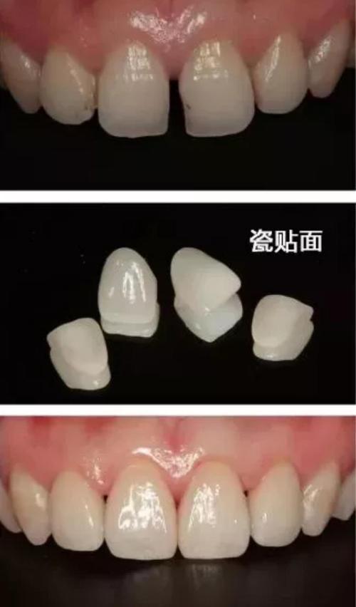 根管治疗烤瓷牙冠牙缝发黑,娱乐圈里都是谁是烤瓷牙