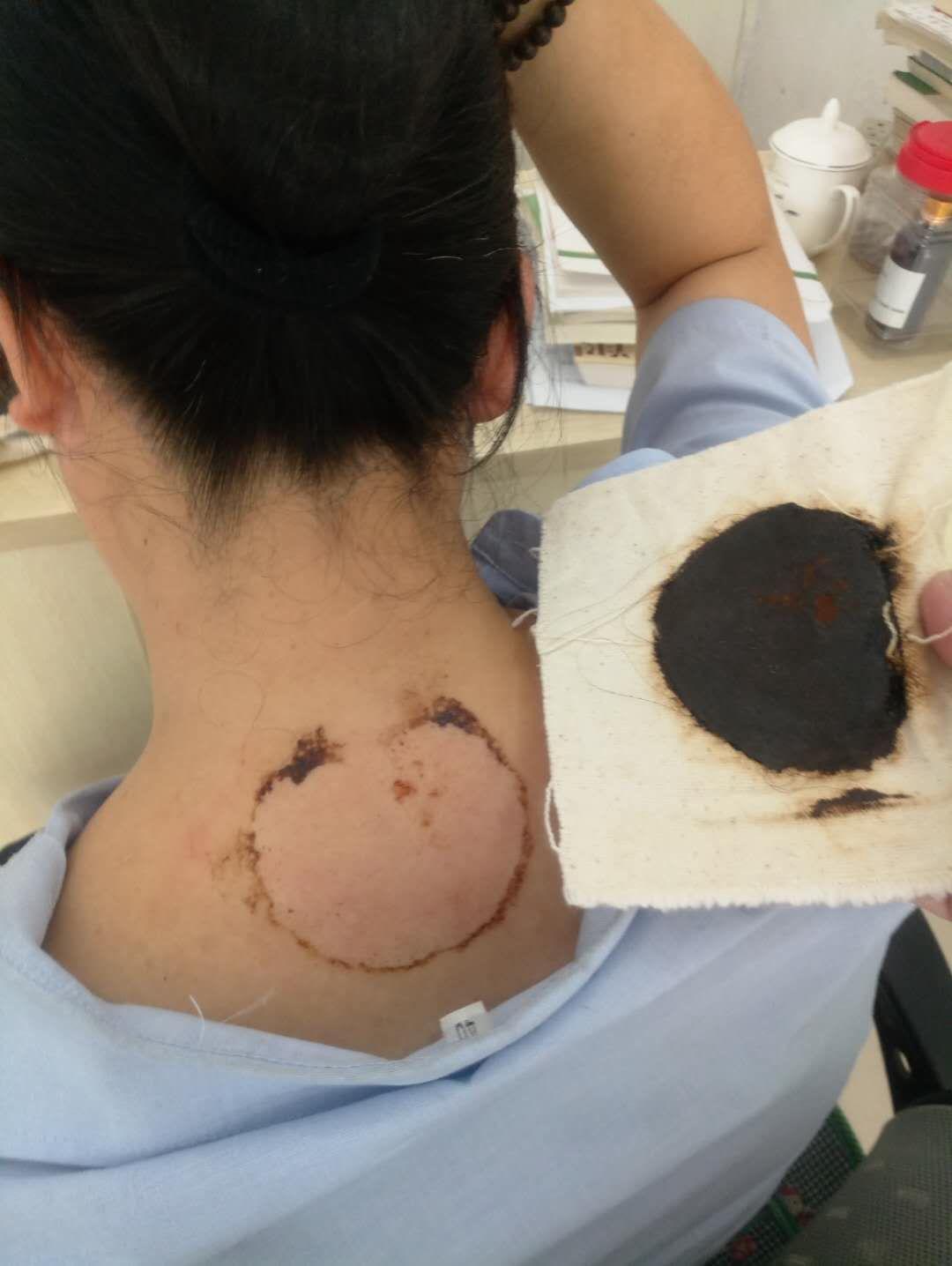 中医针灸治疗颈椎病原理,颈椎病针刀按摩针灸哪种方法好