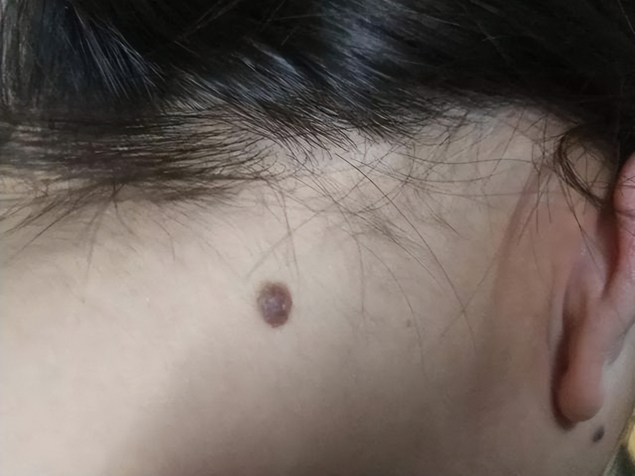 黑痣长在脸上各部位代表什么图片,医生说黑痣有癌变的可能怎么办