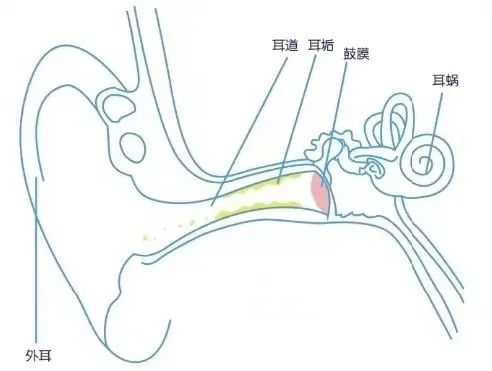 小时候经常掏耳屎长大了没掏,儿童掏耳屎为啥要3天后才掏