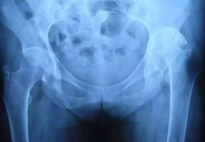 治疗强直性脊柱炎最权威的老中医,强直性脊柱炎治疗最好的办法是