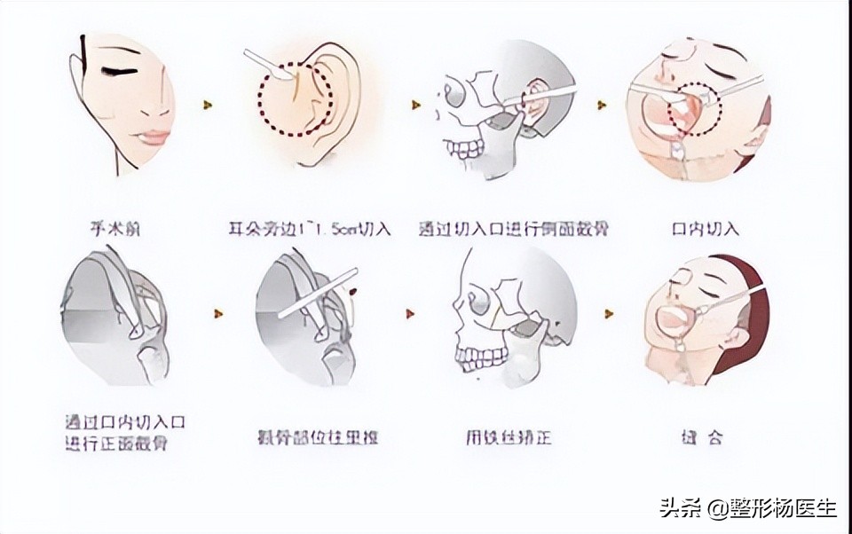 颧骨内推耳前凸起,鼻骨内推和颧骨内推可以一起做吗