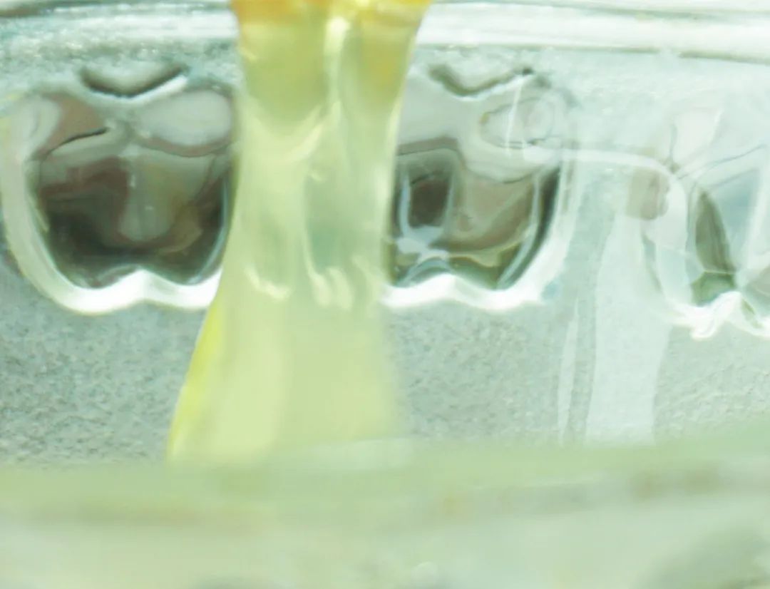 白带呈水样有血丝有腥臭味,孕18周有脓性白带带血丝