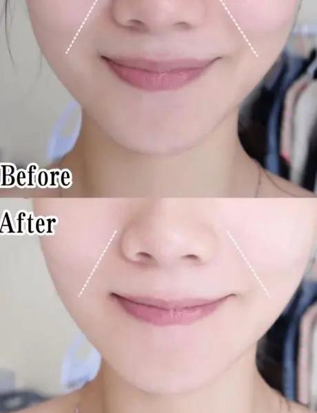 法令纹相当于什么,法令纹是填充还是除皱