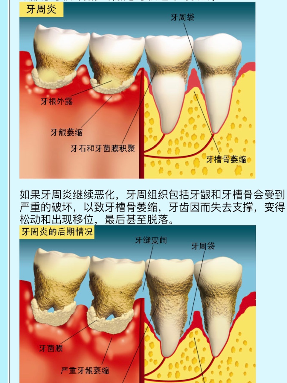 怎么选一款护牙龈的牙膏,防治牙龈炎最好的牙膏