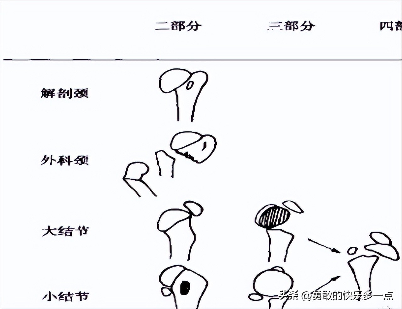 肱骨近端骨折,肱骨近端骨折康复训练