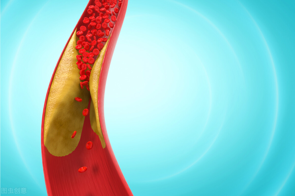 医生总推荐更贵的球囊？球囊和支架哪个好，作为患者该如何选择