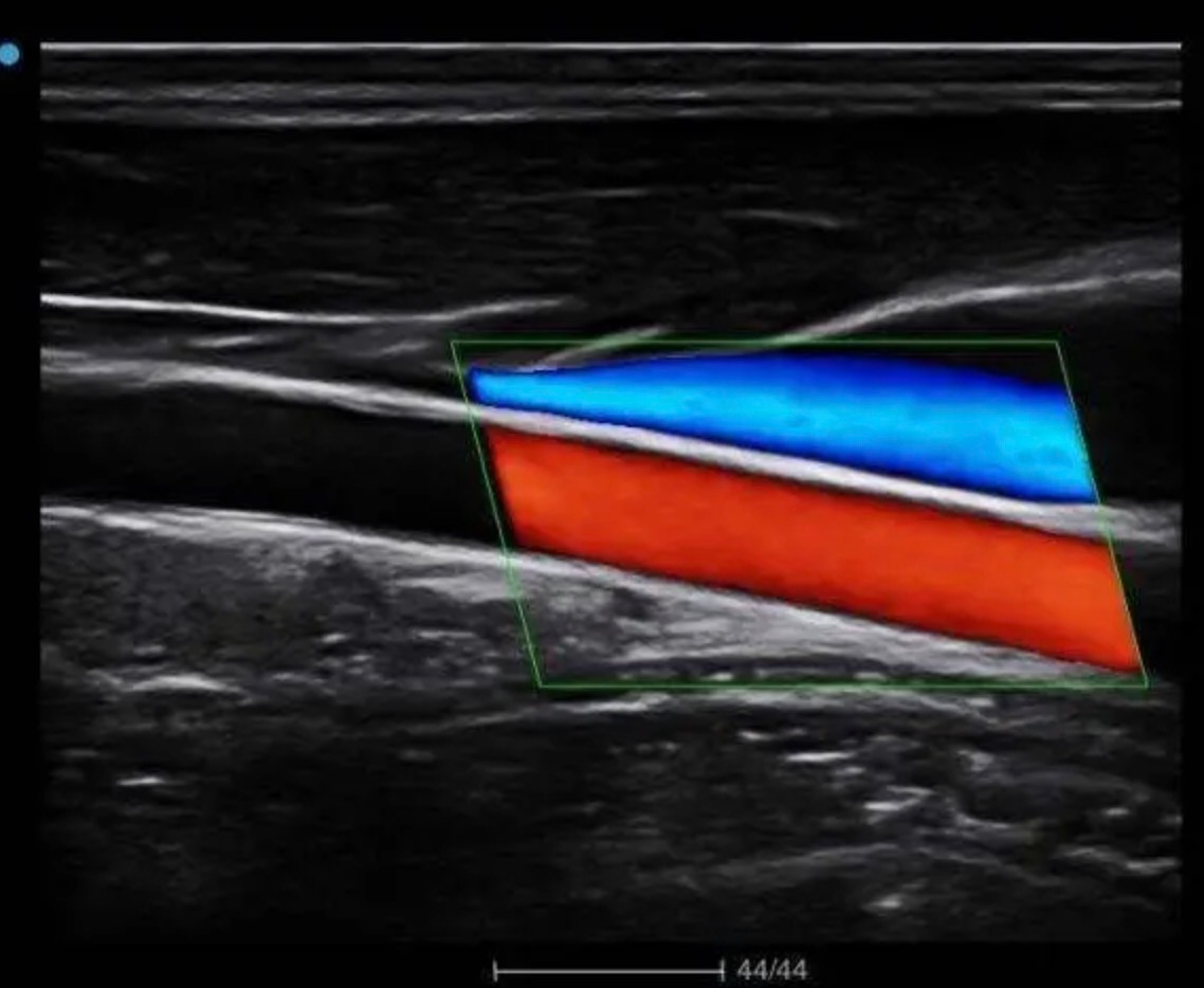 肢体总是莫名的不舒服想动,肢体麻木是属于癌症早期征兆吗