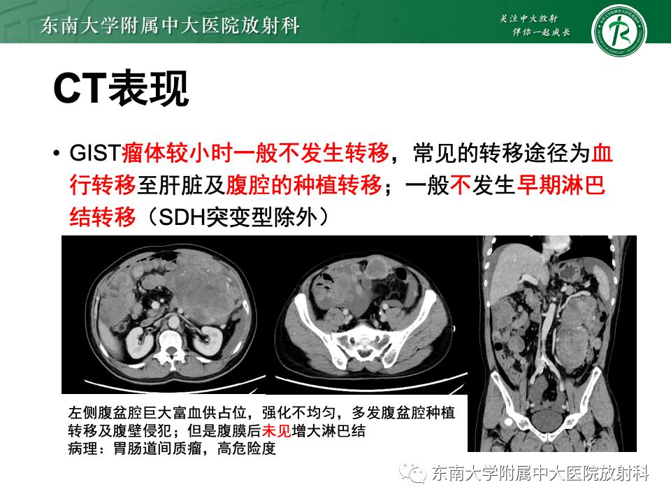小肠间质瘤最新治疗中药方,小肠间质瘤基因检测