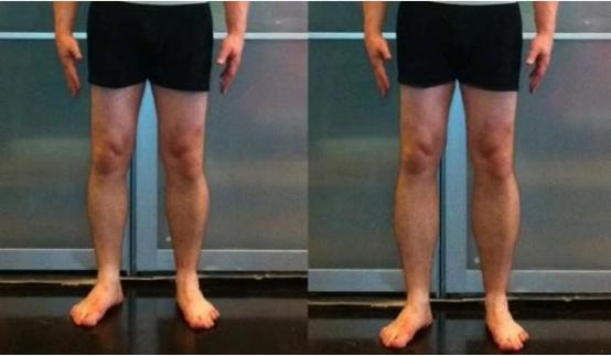 李亚诺断骨手术,断骨增高7.2厘米的李亚诺现状