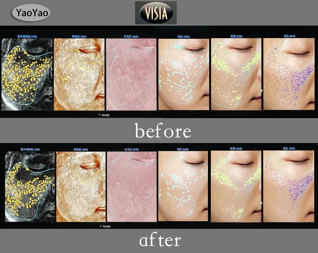 美肌试颜室‖直播见证，4周院线护肤的逆袭之路