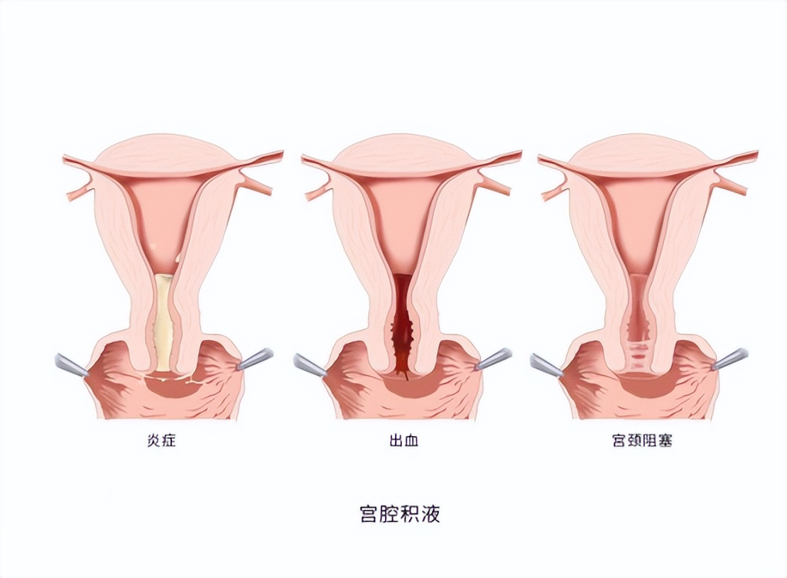 子宫性不孕要如何诊断,查不孕不育查出宫颈病变