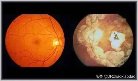 脉络膜增厚怎么解决,脉络膜增厚会怎么样